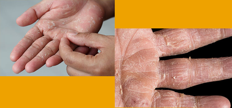 Photographies de mains présentant les symptômes de l'allergie de Type IV